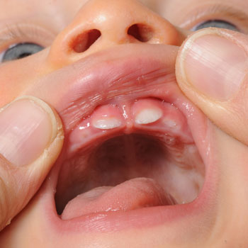Bild von einem Kindermund mit Zähnen, die dabei sind, zu wachsen
