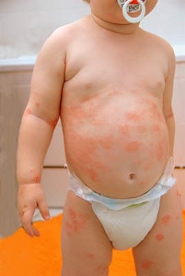 Hautrötungen bei einem Baby aufgrund Neurodermitis